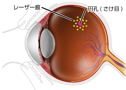 網膜円孔・網膜裂孔